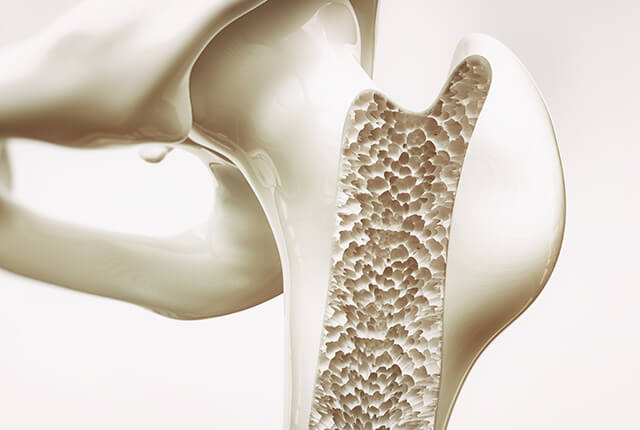 骨粗鬆症のイメージ