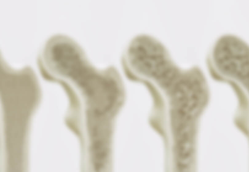 骨粗鬆症イメージ